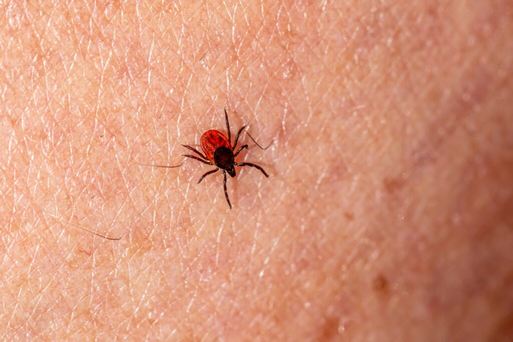Person showing pain and redness around a fresh black widow spider bite