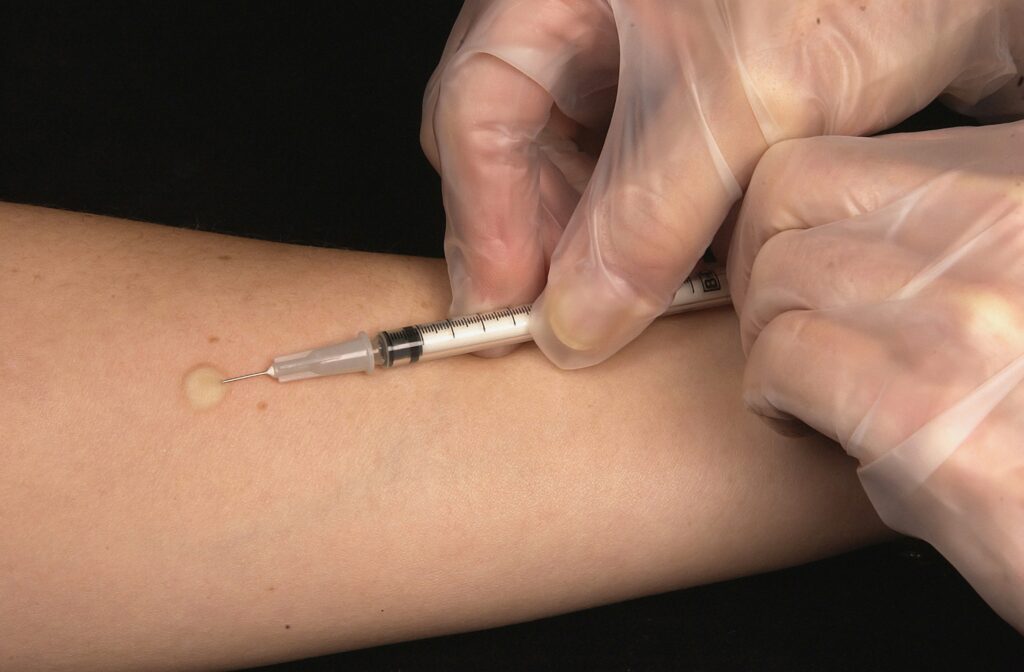 Doctor performing allergy skin test with insect venom extract
