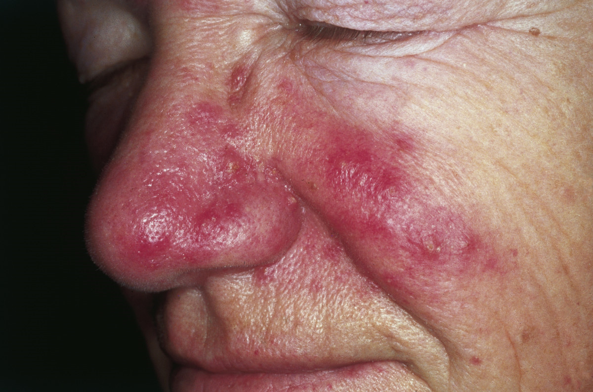 The Connection Between Face Mites and Rosacea (image credits: M. Sand, D. Sand, C. Thrandorf, V. Paech, P. Altmeyer, F. G. Bechara: Cutaneous lesions of the nose. In: Head & face medicine Band 6, 2010, S. 7, ISSN 1746-160X. doi:10.1186/1746-160X-6-7. PMID 20525327.. (Review). Open Access, CC BY 2.0, https://commons.wikimedia.org/w/index.php?curid=15606564)