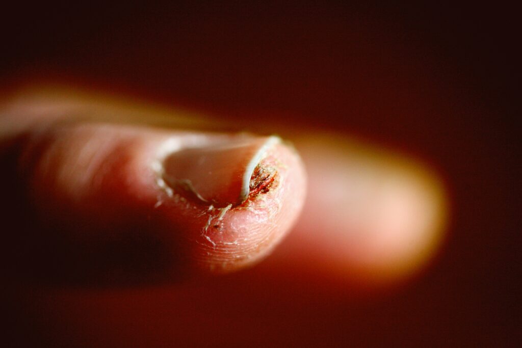 A close-up of a human skin with visible swelling caused by a developing botfly larva beneath the surface.