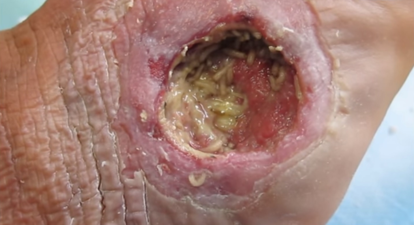 How These Tiny Surgeons Actually Work (image credits: Лечение ран личинками. Диабетическая стопа / Maggot debritment therapy. Diabetic foot, CC BY 3.0, https://commons.wikimedia.org/w/index.php?curid=46390555)