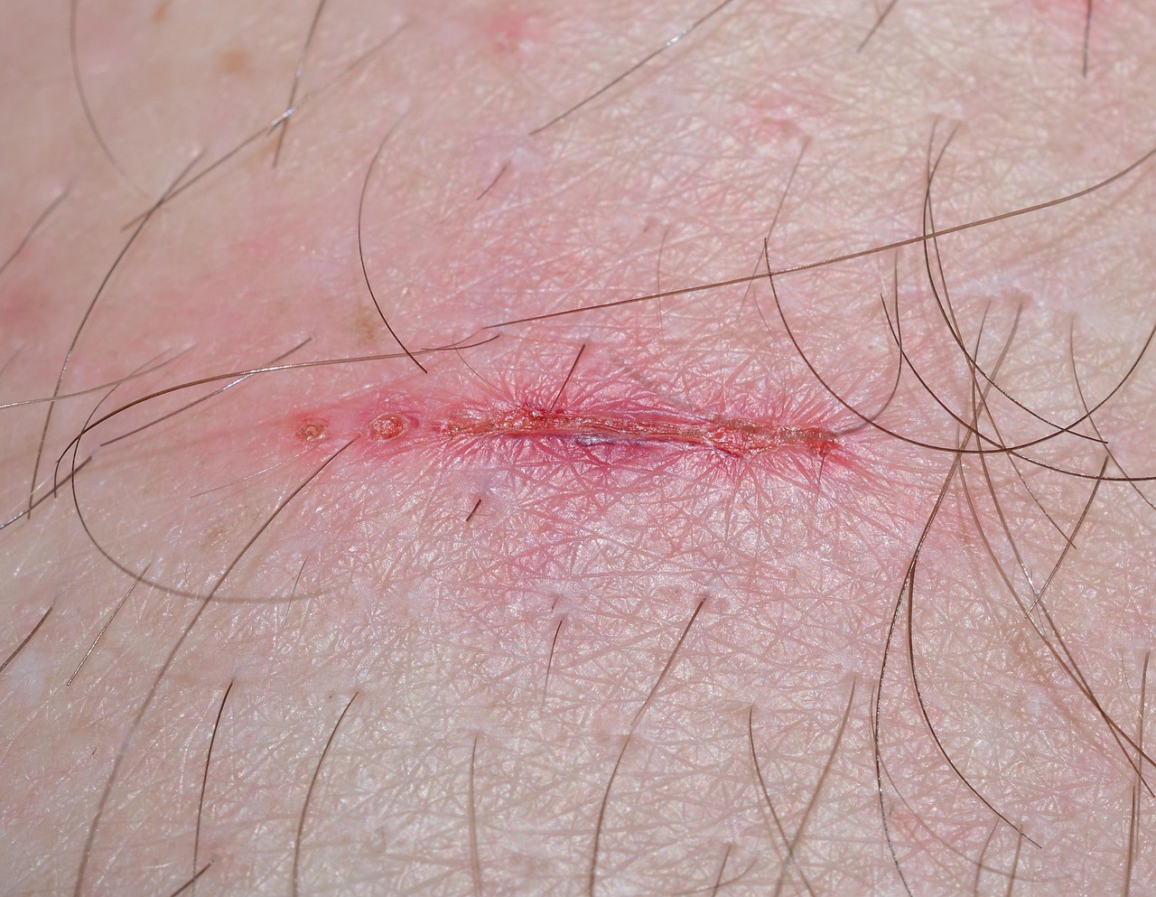 When Doctors Prescribe Creepy Crawlies (image credits: pixabay)