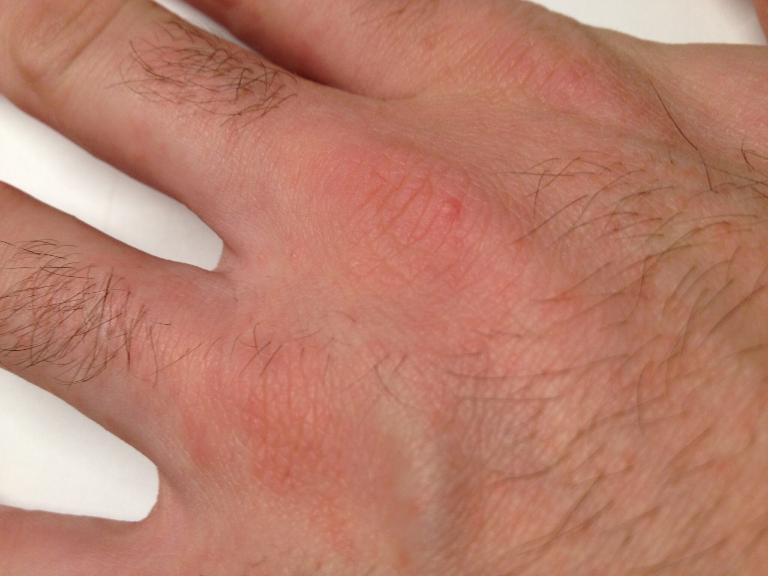 Scabies: The Persistent Skin Invaders (image credits: By Fhgd, CC BY-SA 3.0, https://commons.wikimedia.org/w/index.php?curid=19082371)