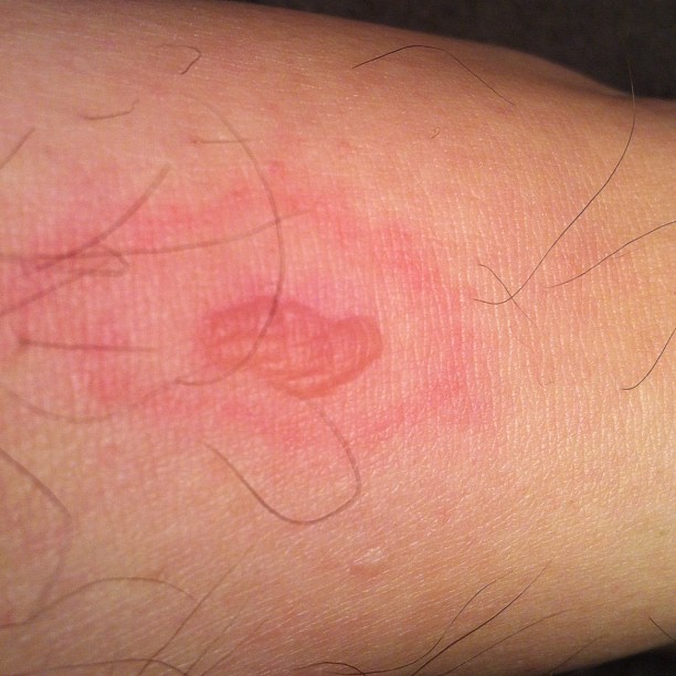 The Great Spider Bite Myth (image credits: wikimedia)