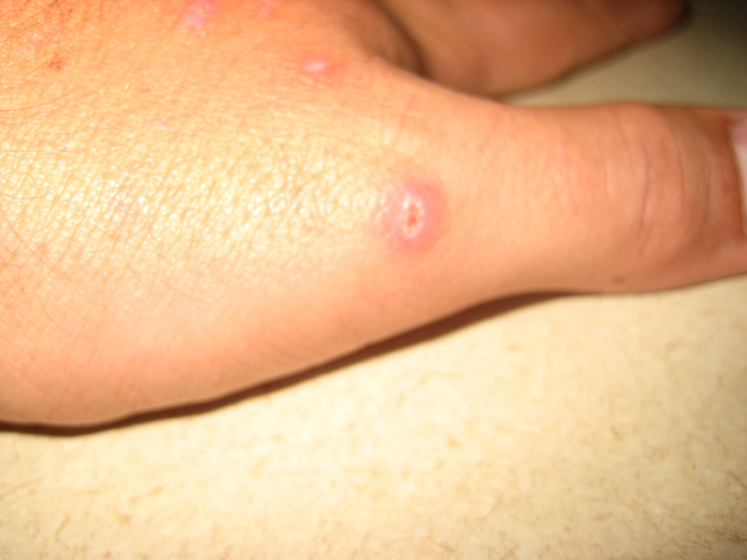 The Reality of Spider Bites (image credits: wikimedia)